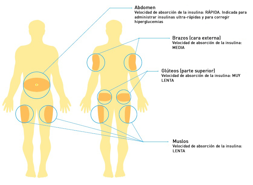 Tratamientos para la diabetes: Insulina